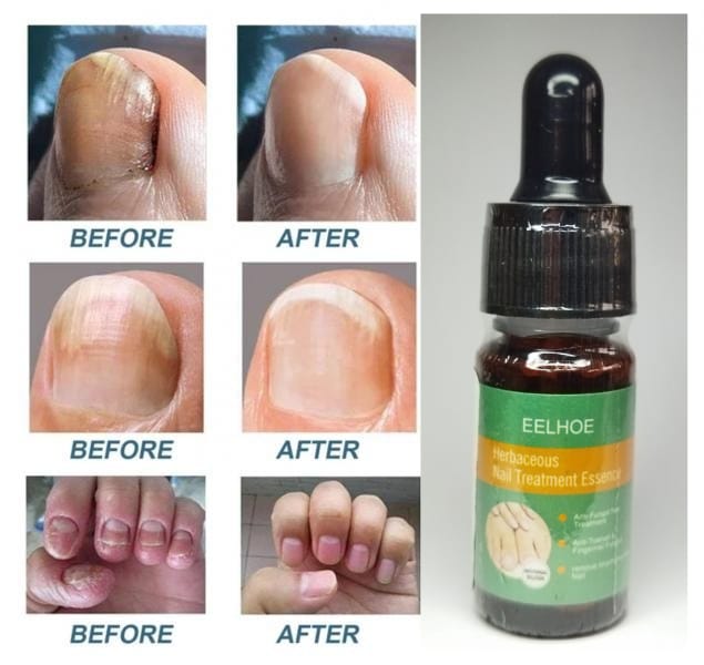 TRATAMIENTOS HONGOS Transparente